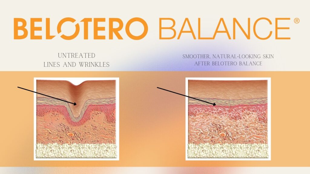 Belotero balance skin perfect brothers