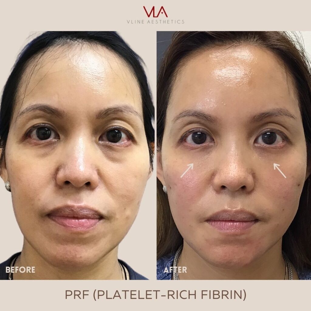 Eye Rejuvenation - PRF skin perfect brothers
