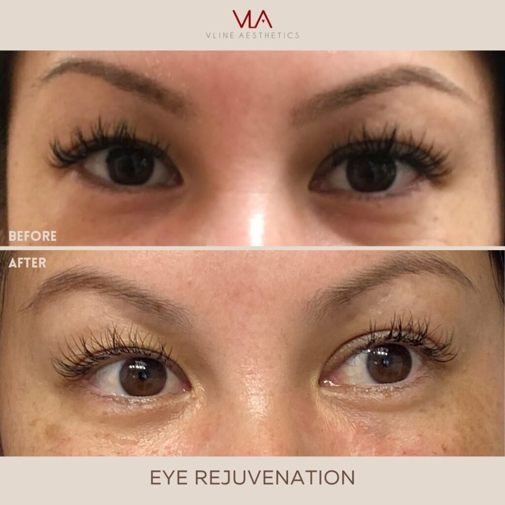 Skin Perfect Brothers Eye Rejuvenation - Revise (2)