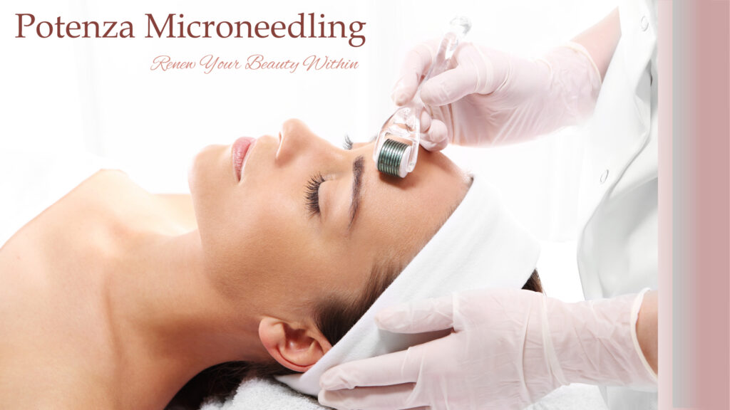 Potenza RF Microneedling Skin Perfect Brothers micro needling