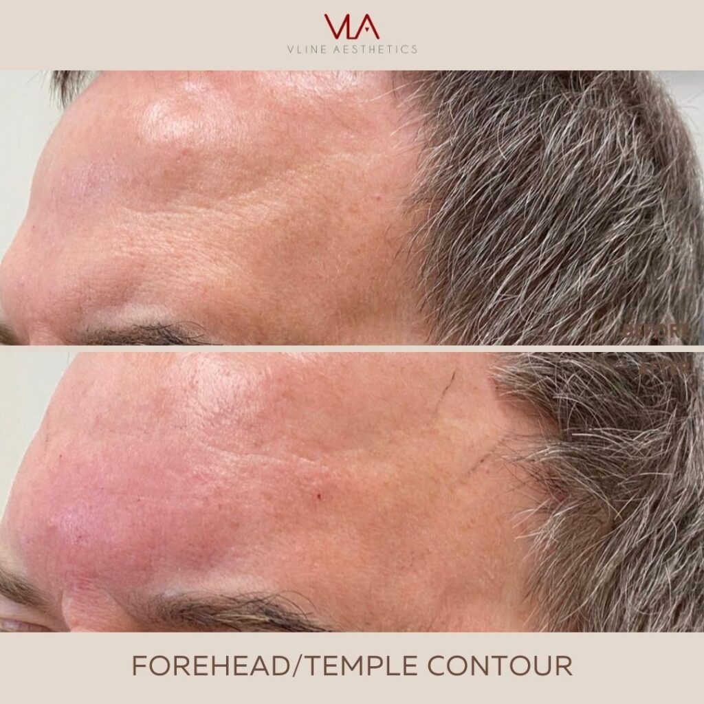 forehead temple contour skin perfect brothers