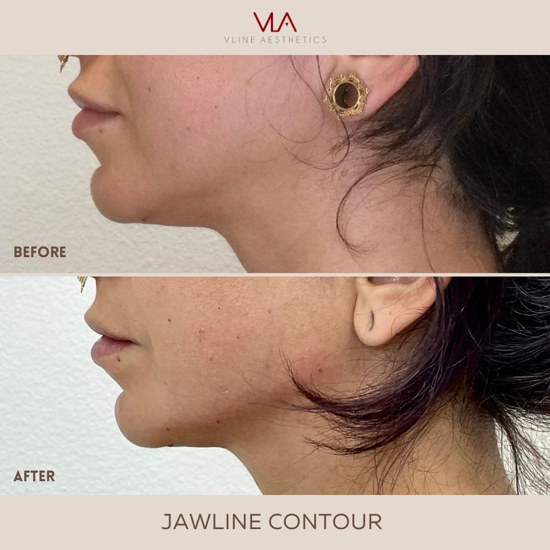 jawline lift skin perfect brothers before after