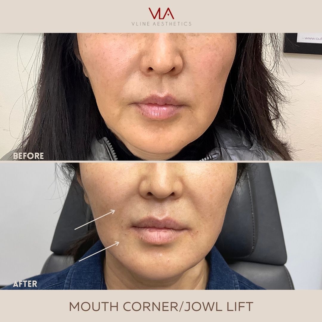 MOUTH CORNERJOWL LIFT (1)