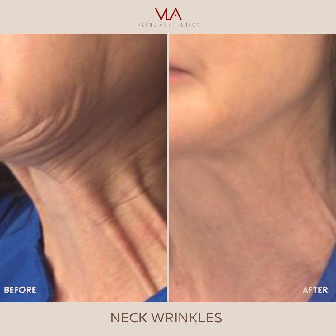Skin perfect brothers Neck Wrinkles