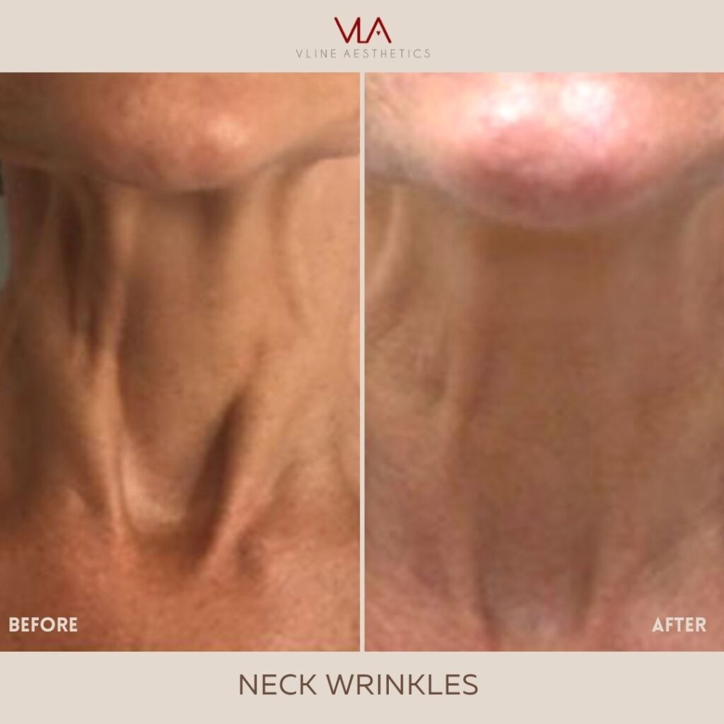 wrinkles treatments