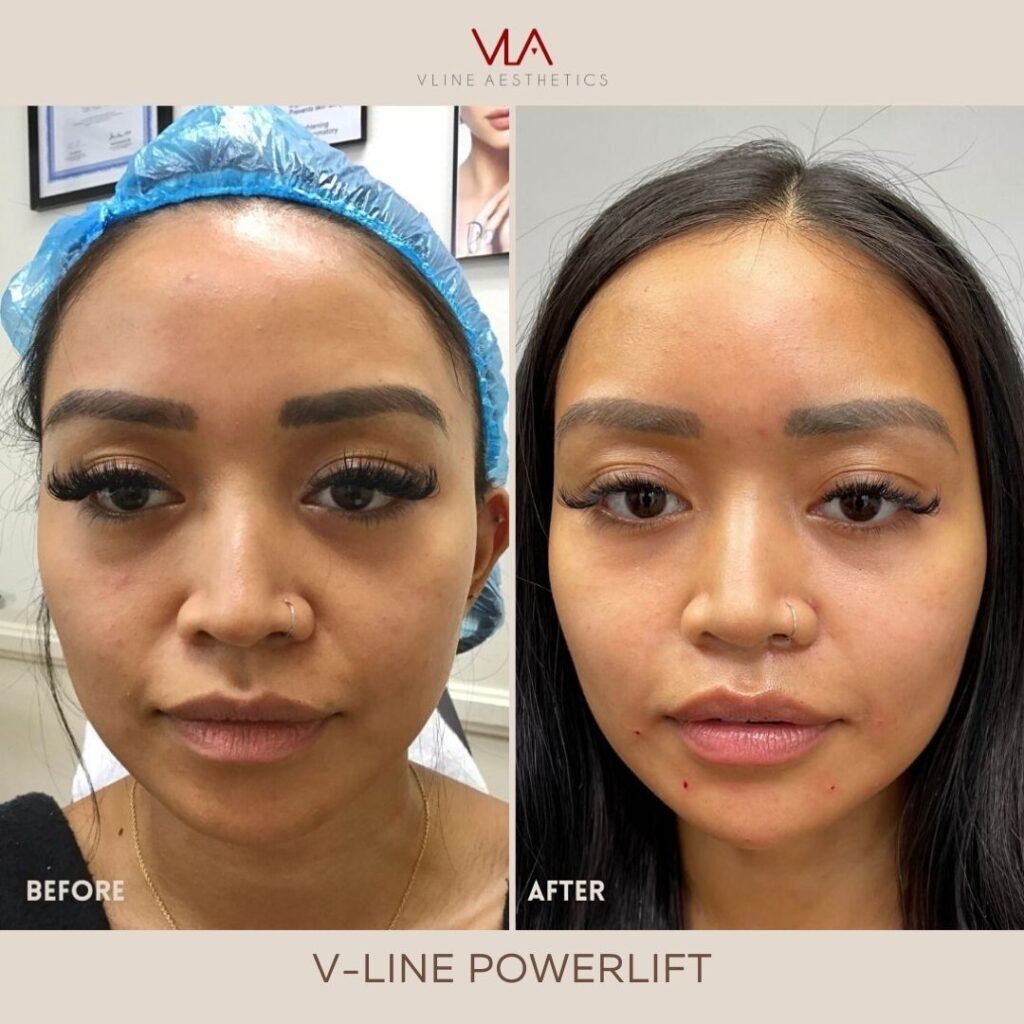 V Line Power Lift - Influencer Skin Perfect Brothers