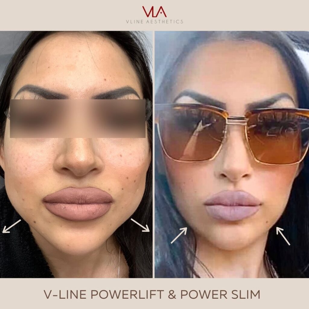 Skin perfect brothers V line aesthetics Power Slim and v line power lift