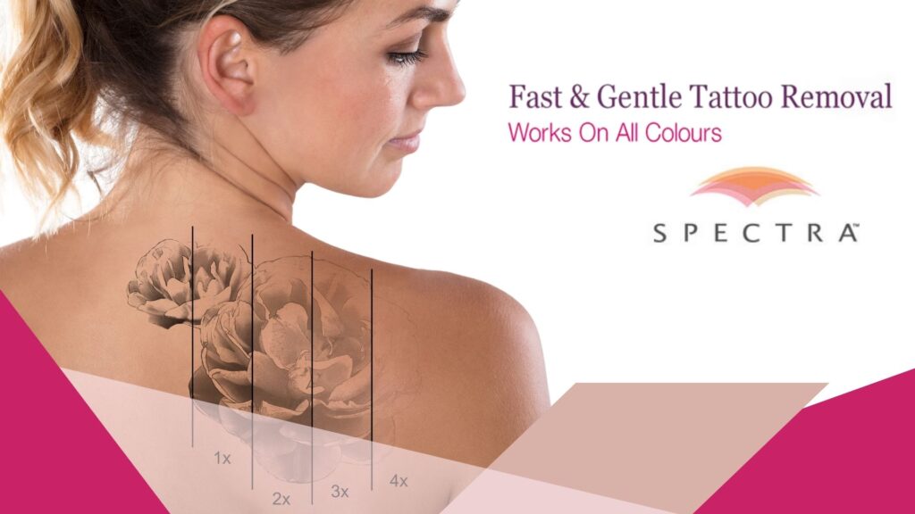 laser tattoo removal skin perfect brothers