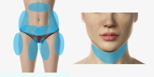 coolsculpting treatment areas