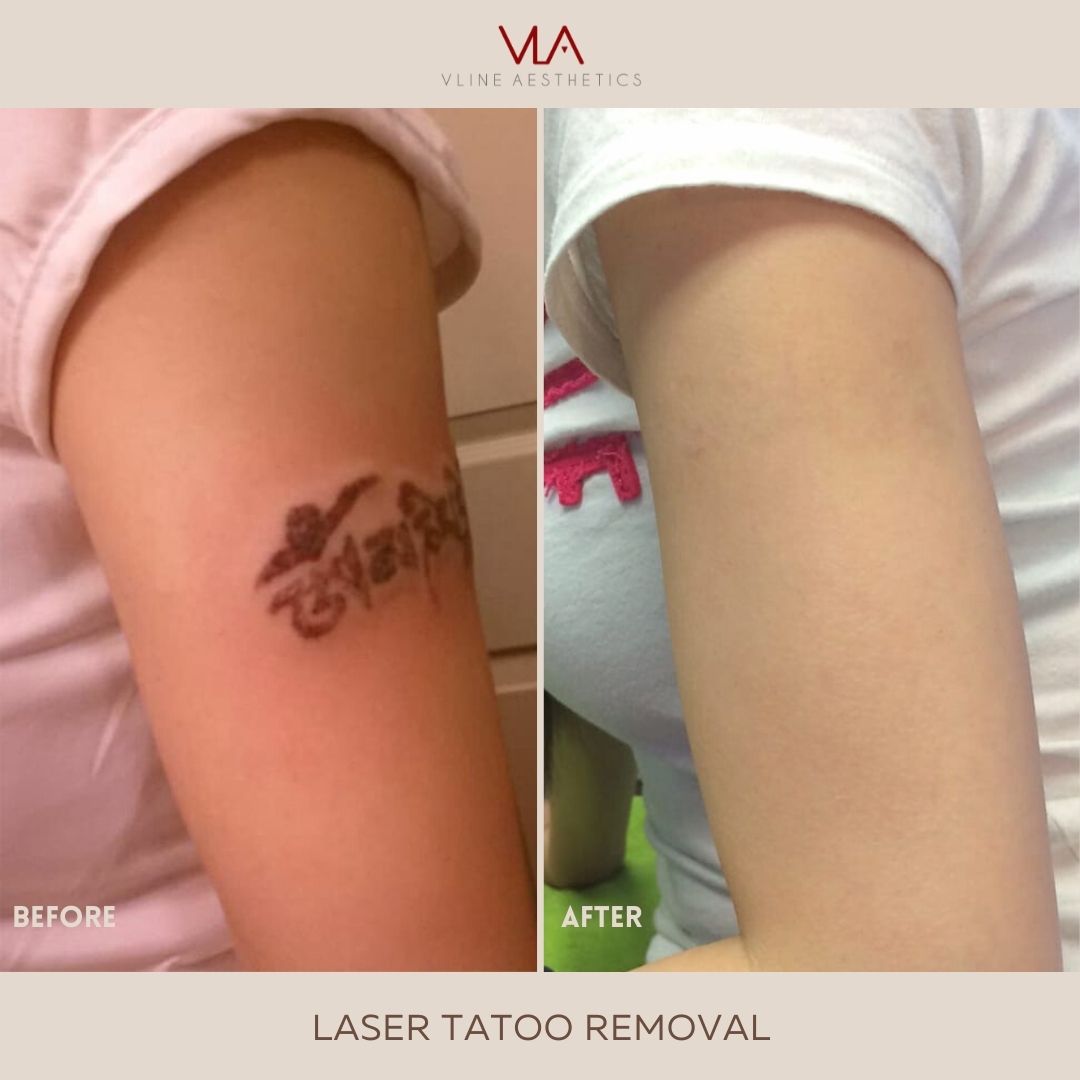 Skin perfect brothers laser tattoo removal