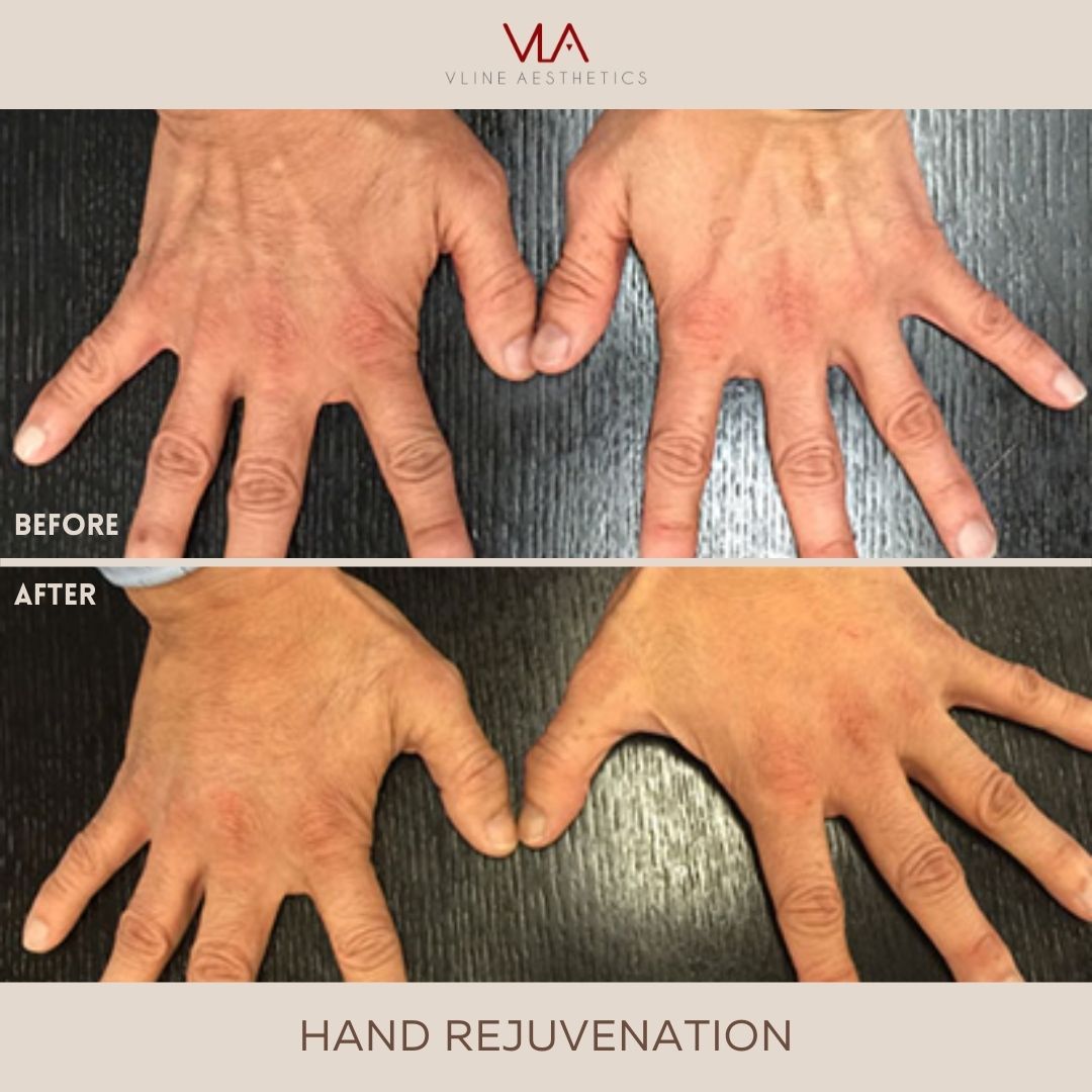 Skin Perfect brothers Hand Rejuvenation