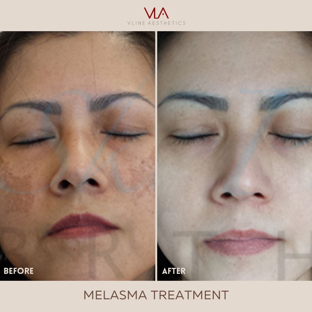 Skin Perfect Brothers Melasma Treatment - Full Face