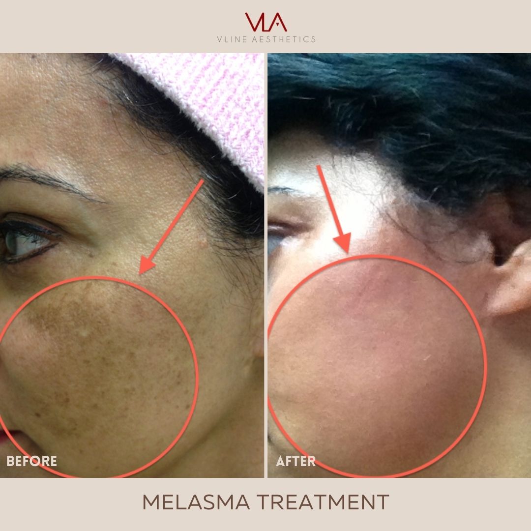 Skin Perfect Brothers Melasma Treatment -