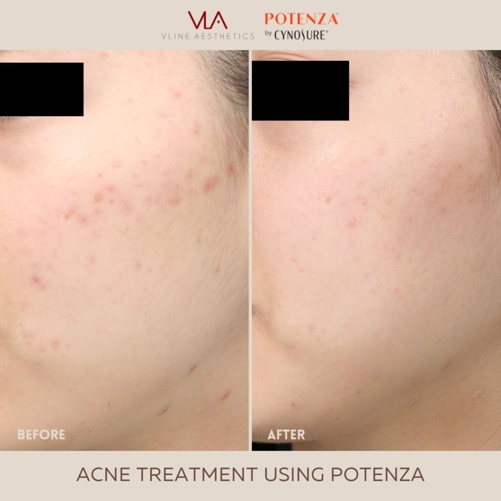 acne treatment skin perfect brothers