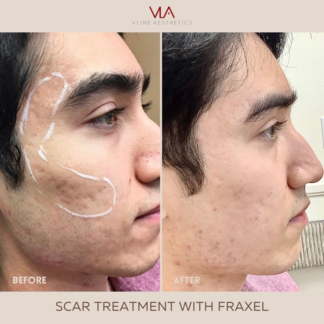 Skin perfect brothers SCAR TREATMENT (1)