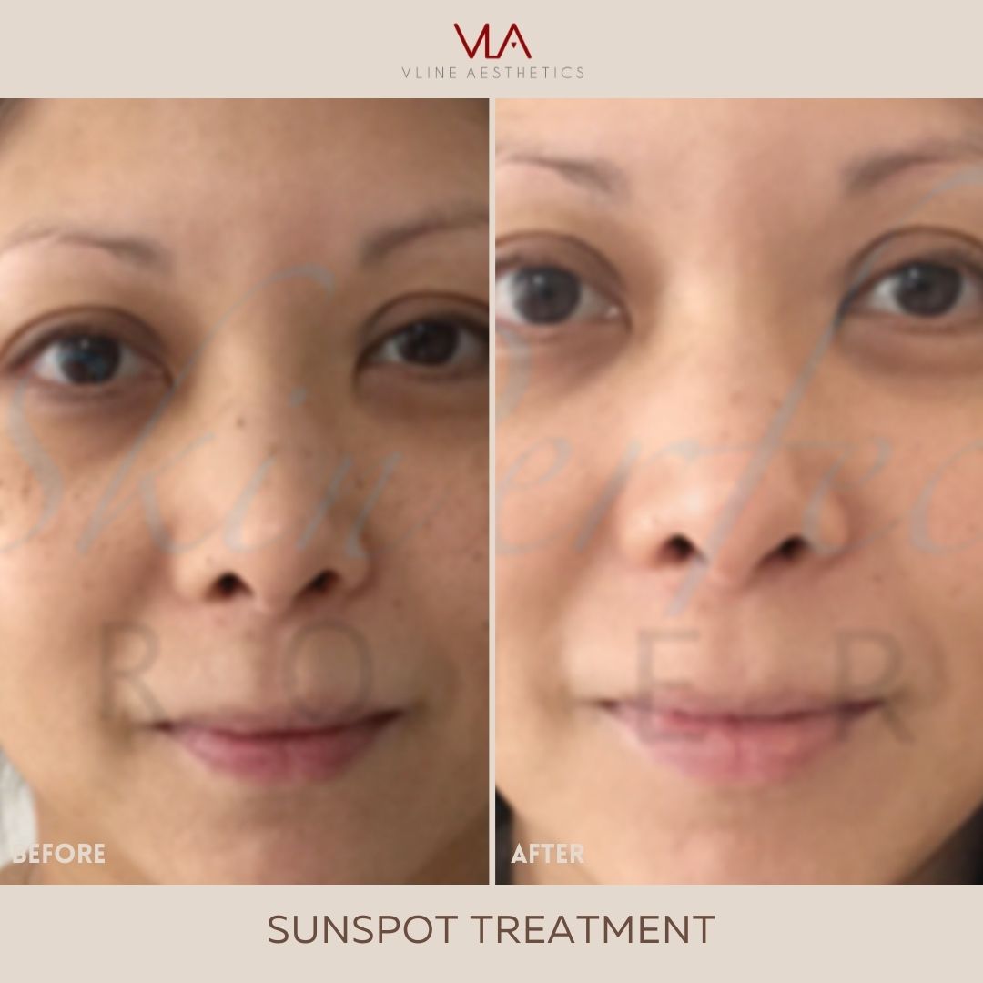 Skin Perfect Brothers Sunspot Age Spot Treatment
