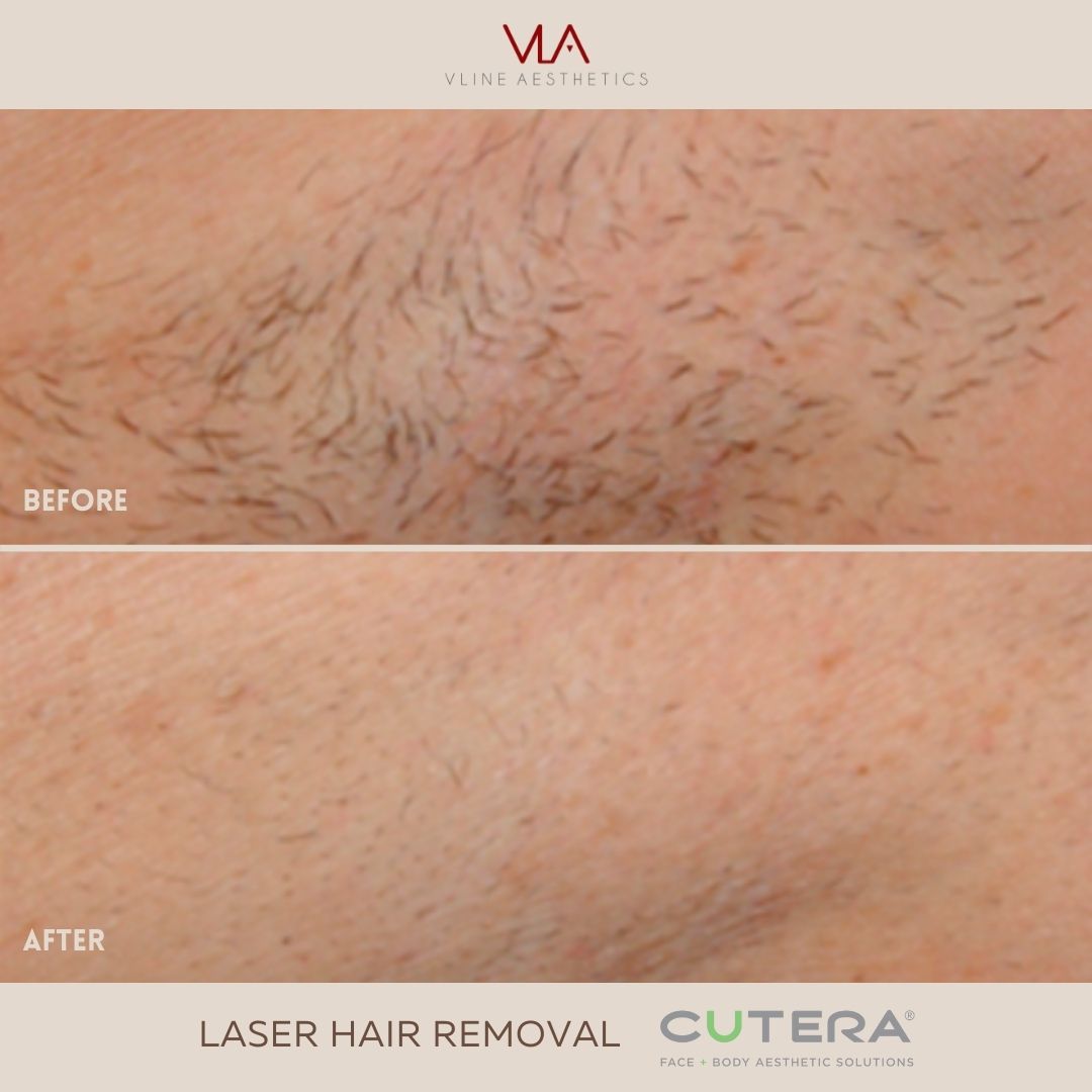Skin Perfect Brothers Laser Hair Removal