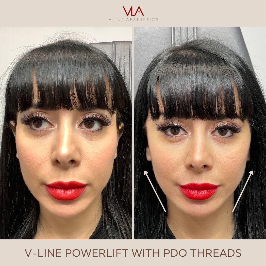 V-LINE POWERLIFT WITH PDO THREADS (1)