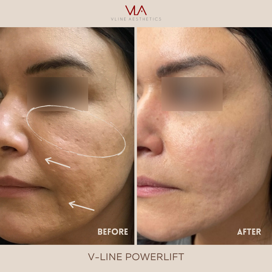 V Line Power Lift Cheek Skin Perfect Brothers