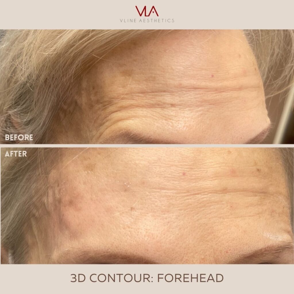 Skin Perfect brothers Forehead wrinkles Treatments