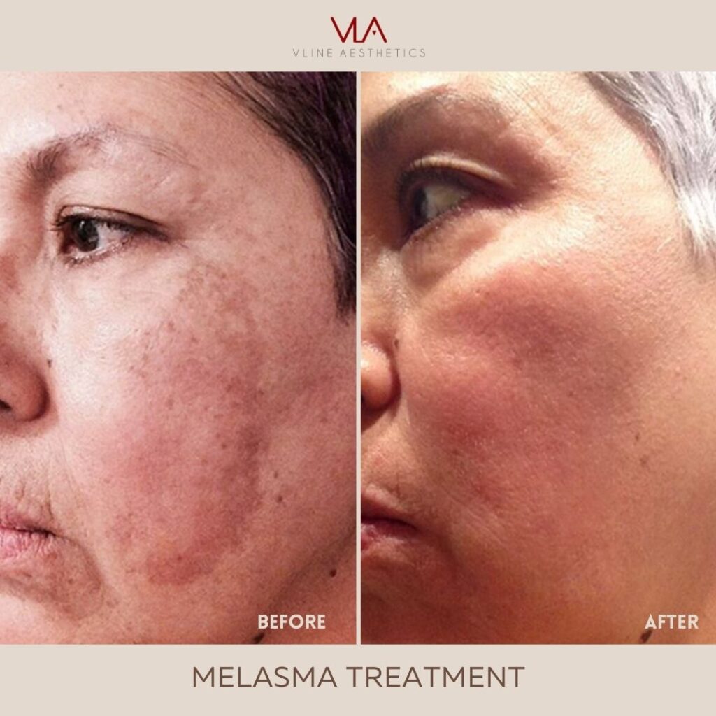 melasma treatment skin perfect brothers
