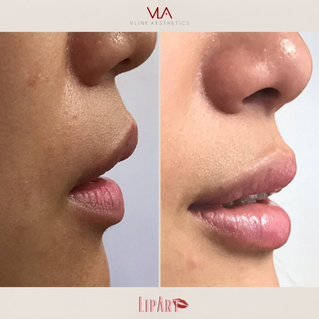 Skin Perfect Brothers Restylane Lip Art