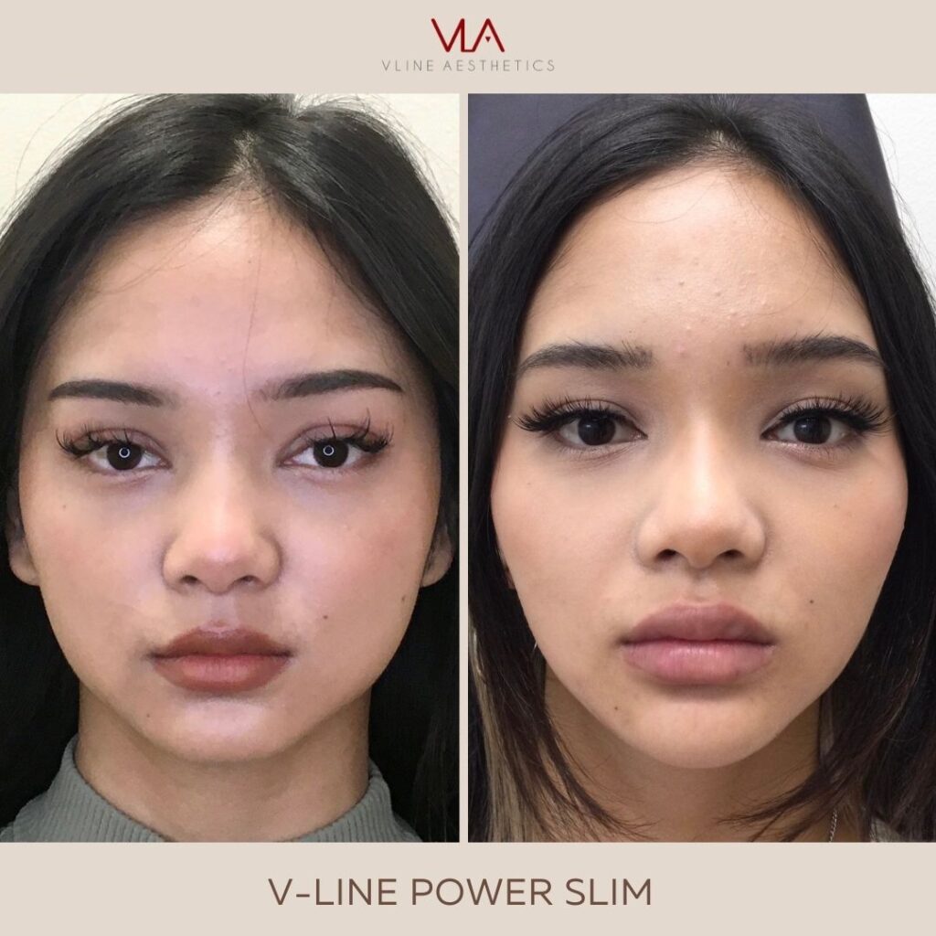 facial slimming medical spa in Los Angeles