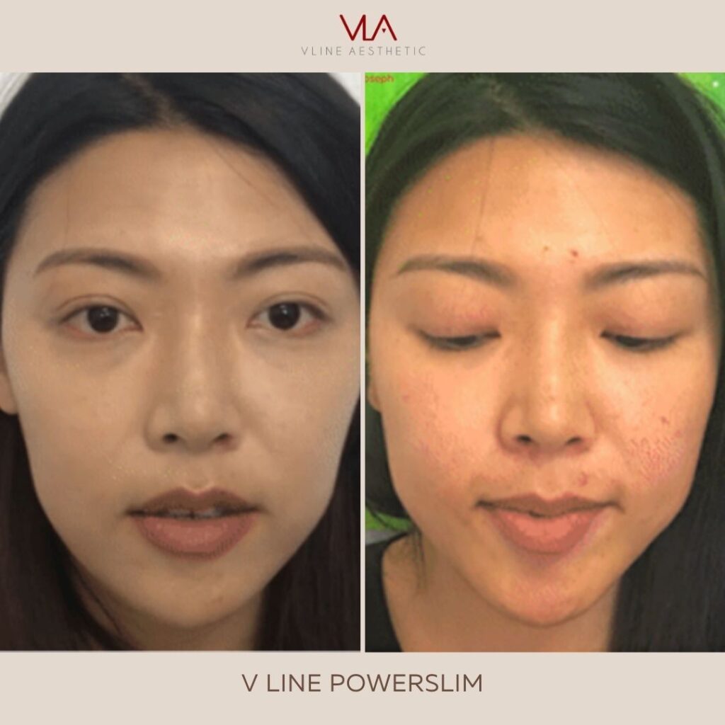 power slim treatment