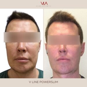 v line power slim skin perfect brothers