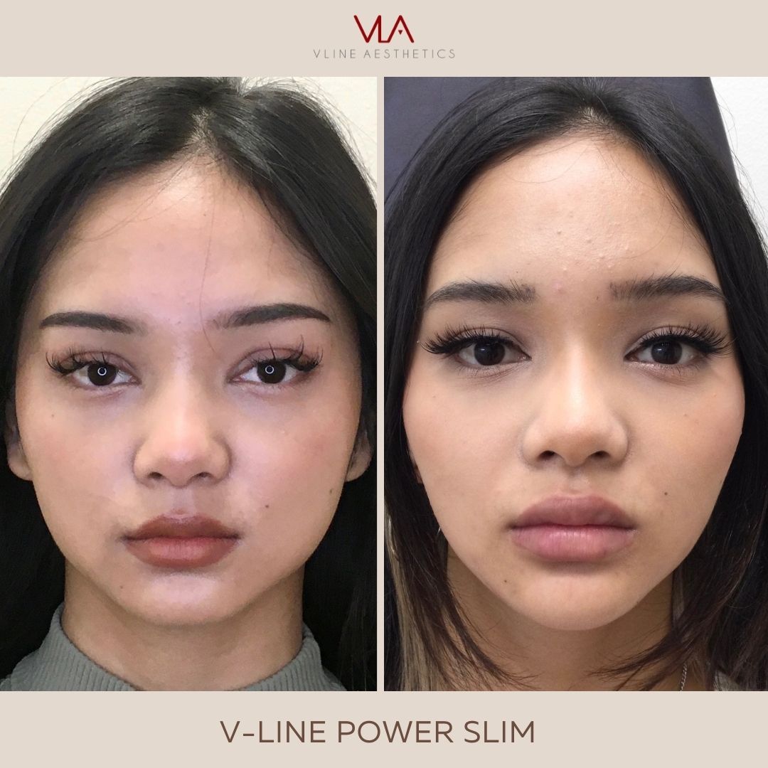 facial slimming medical spa in Los Angeles