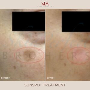 sunspot and sun exposure patient