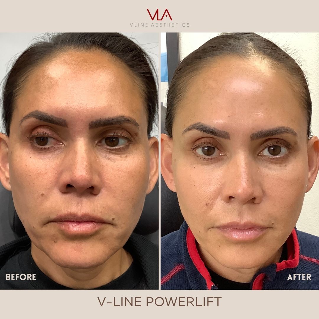 v lift medical spa in Los Angeles