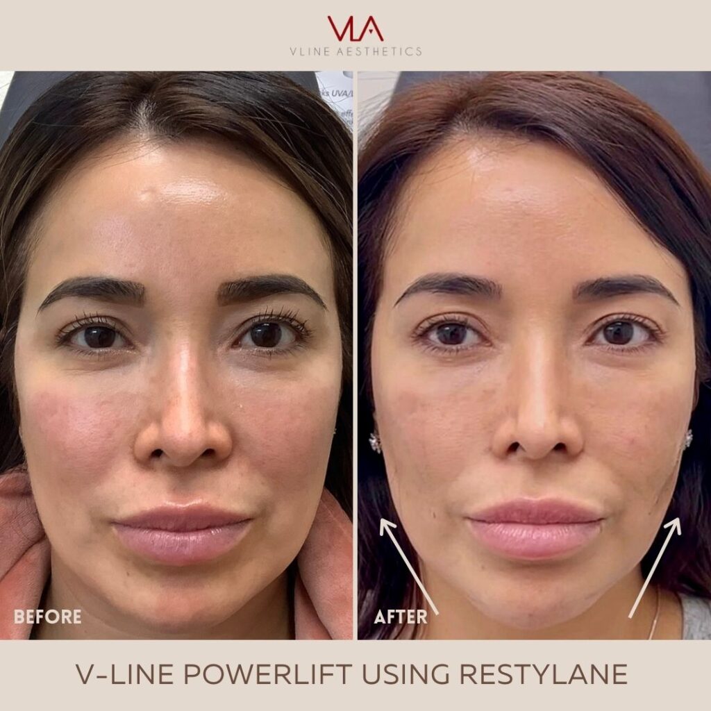 v line power lift skin perfect brothers