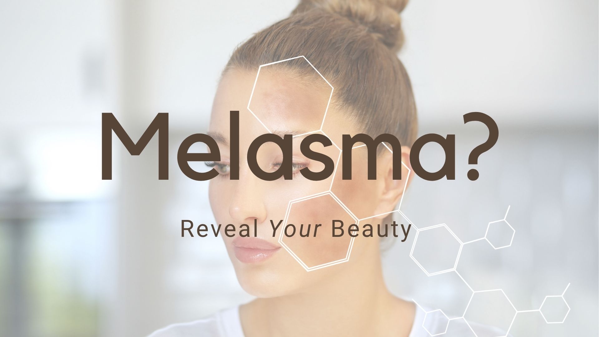 melasma treatment skin perfect brothers