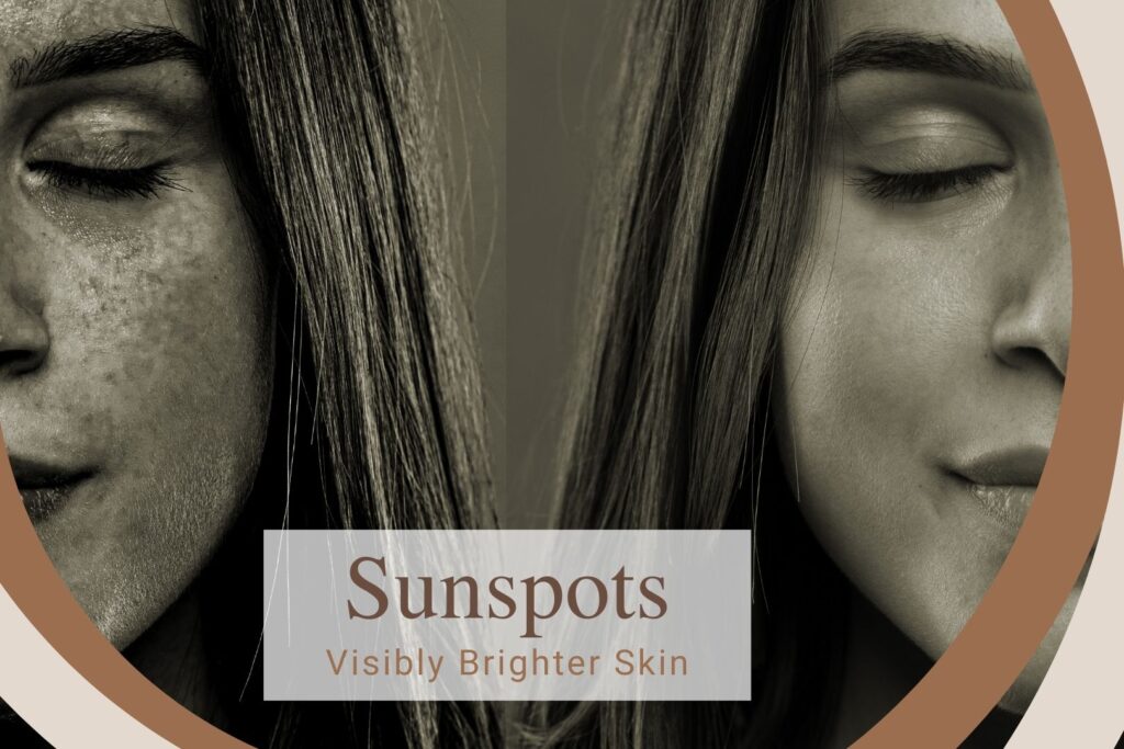 sun exposure treatment skin perfect brothers