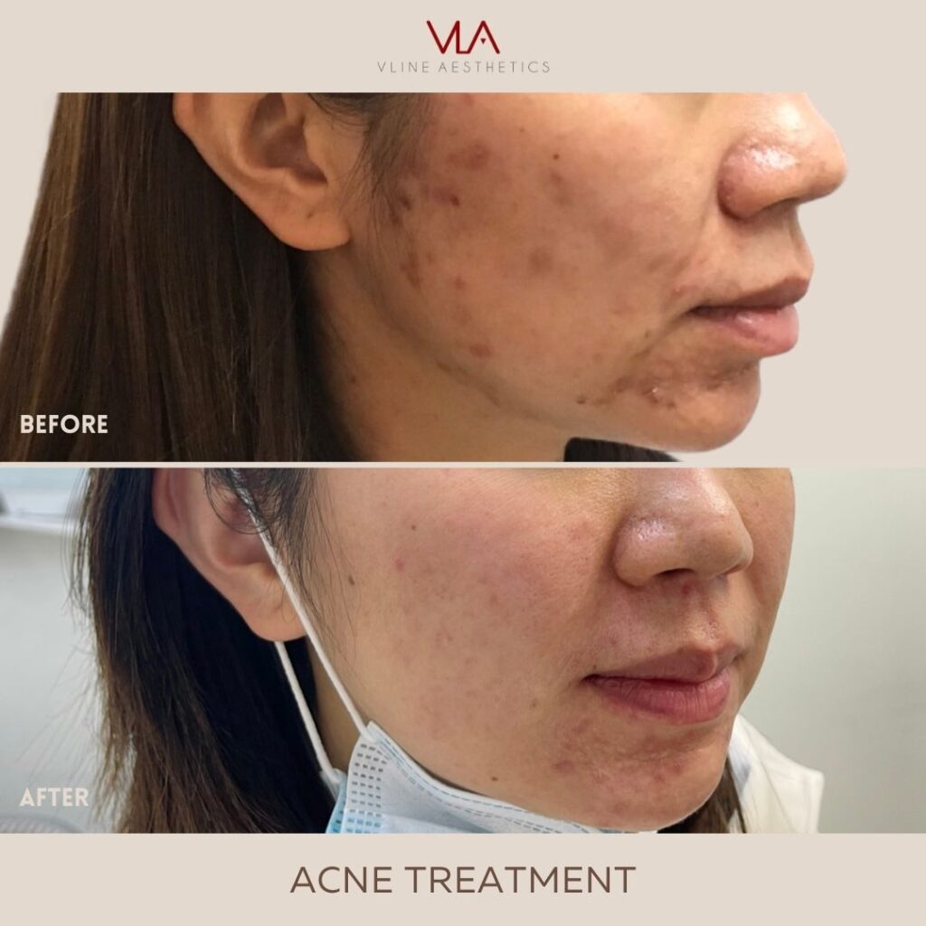 acne improvement before and after