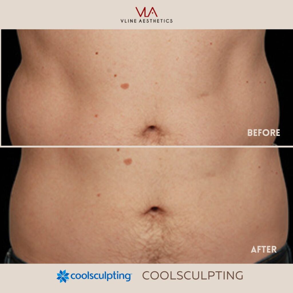 men coolsculpting treatment skin perfect brothers