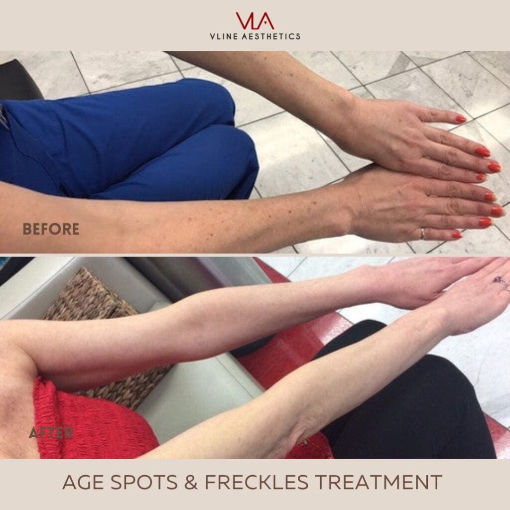 age spots arm treatment ill skin perfect brothers