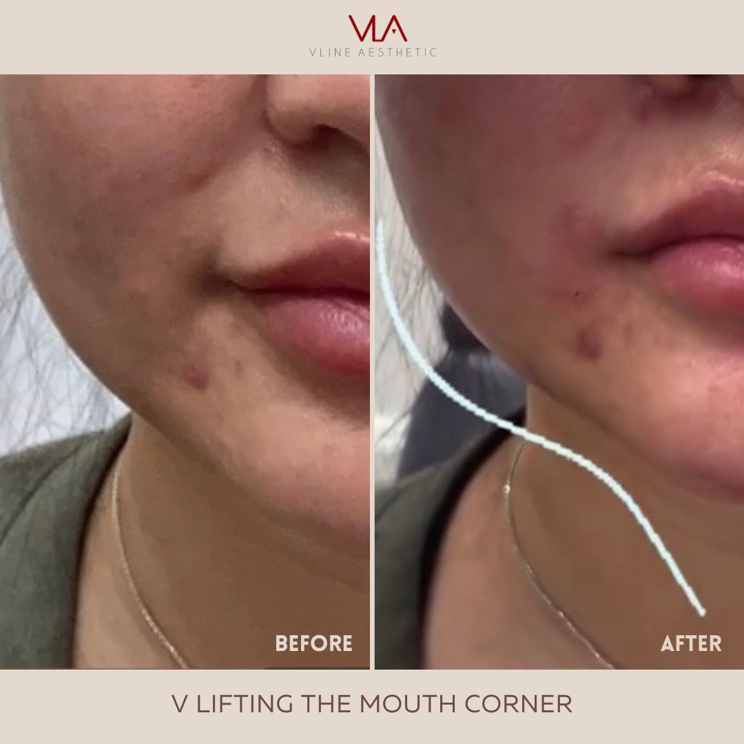v lifting the mouth corner skin perfect brothers