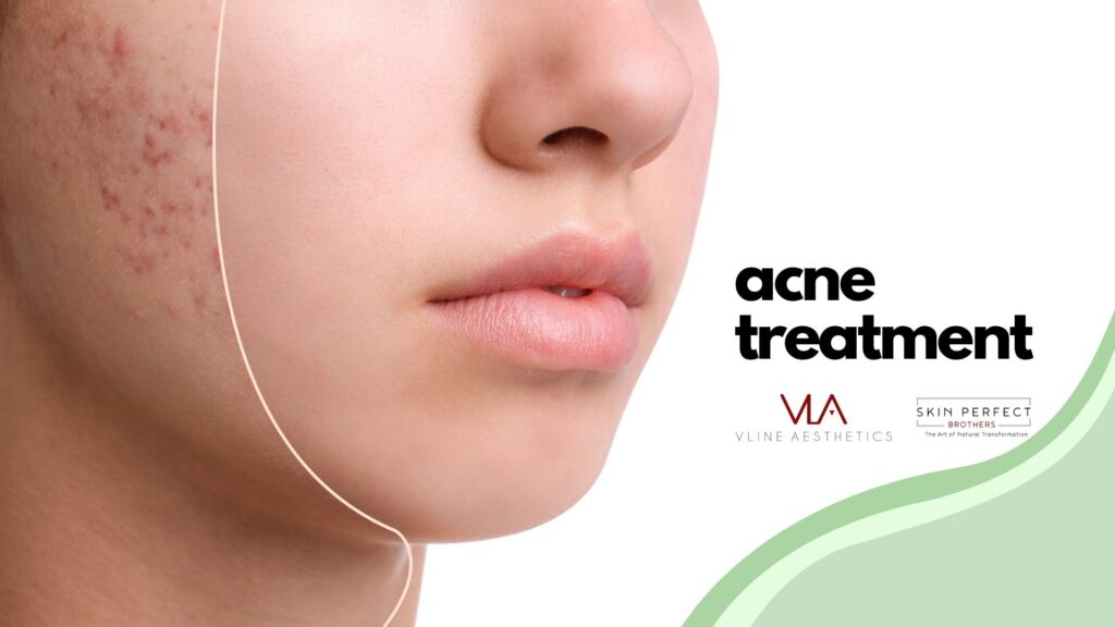 acne treatments at skin perfect brothers