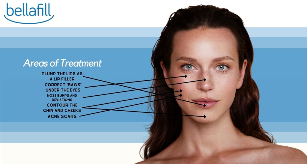 bellafill areas of treatment skin perfect brothers