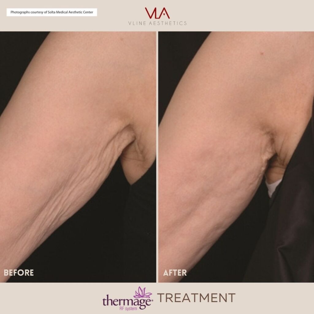 arm treatment skin perfect brothers