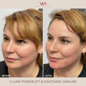chin contour skin perfect brothers