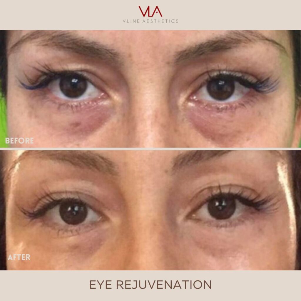 treating eyes skin perfect brothers