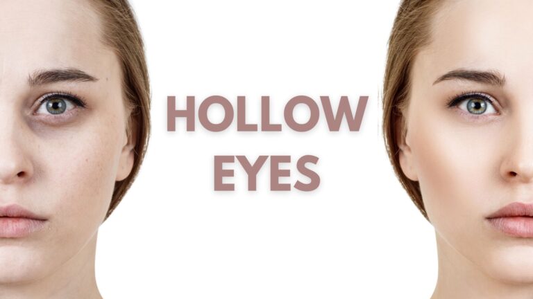 dark circles under eyes skin perfect brothers