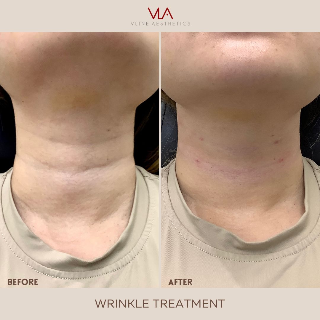 Wrinkles Neck Lift Skin Perfect Brothers