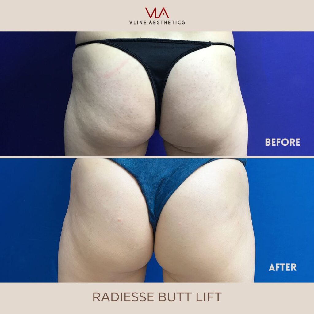 Radiesse Butt Lift Skin Perfect Brothers