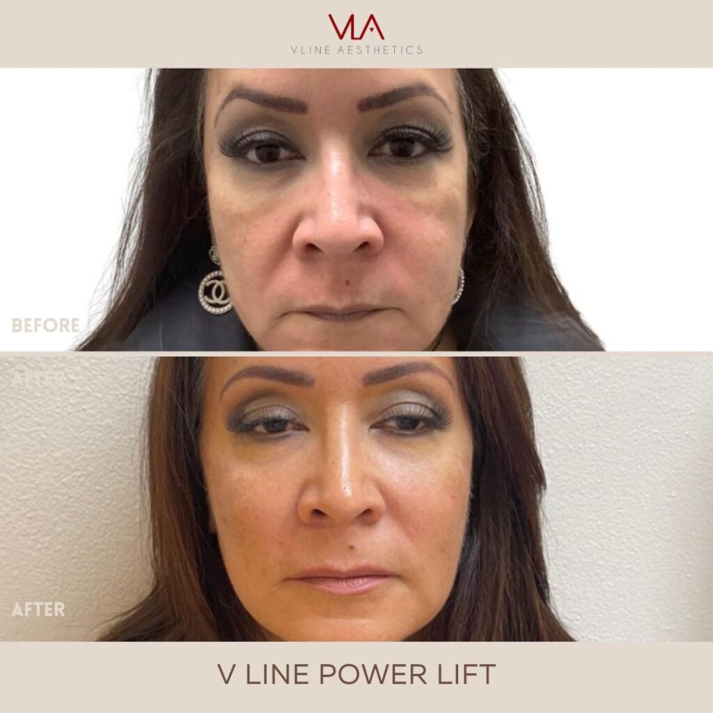 v lift using Radiesse Skin Perfect Brothers