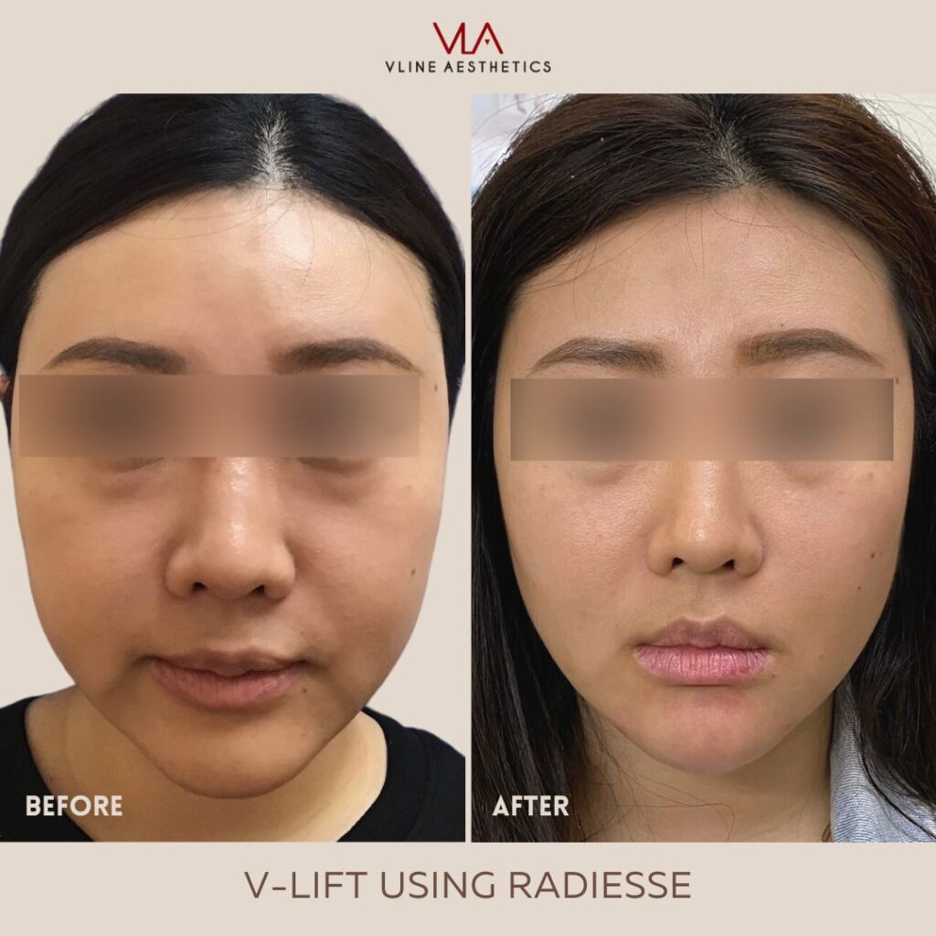 V Lift Using Radiesse Skin Perfect Brothers