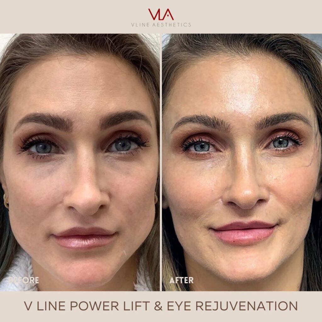 eye rejuvenation skin perfect brothers